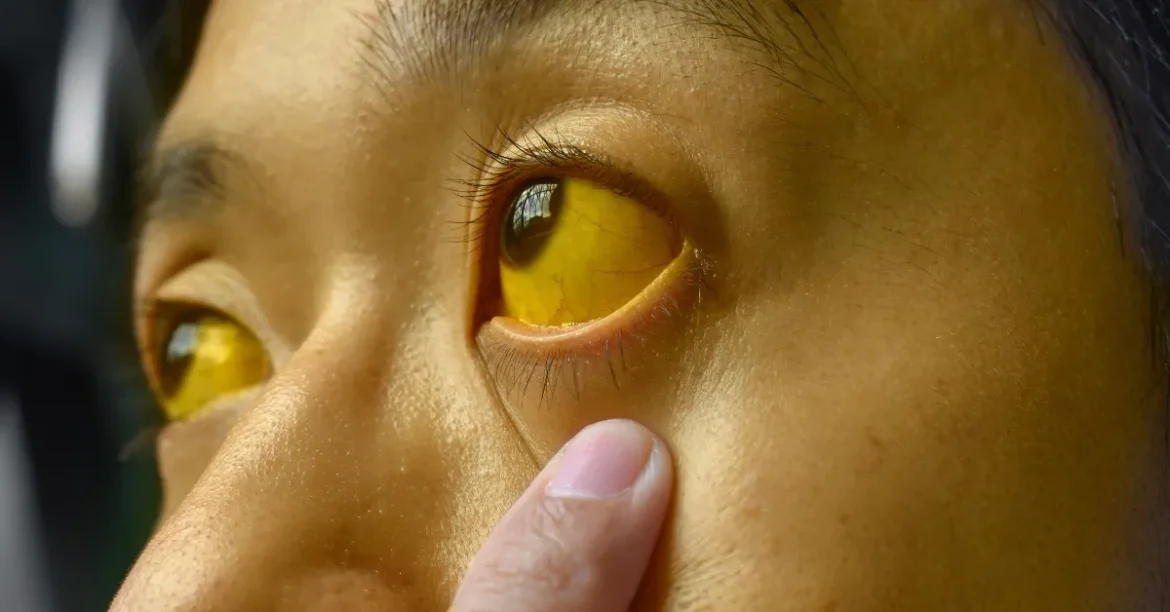Jaundice Symptoms: Yellowing of Skin and Eyes